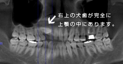右上の犬歯が完全に上顎の中にあります